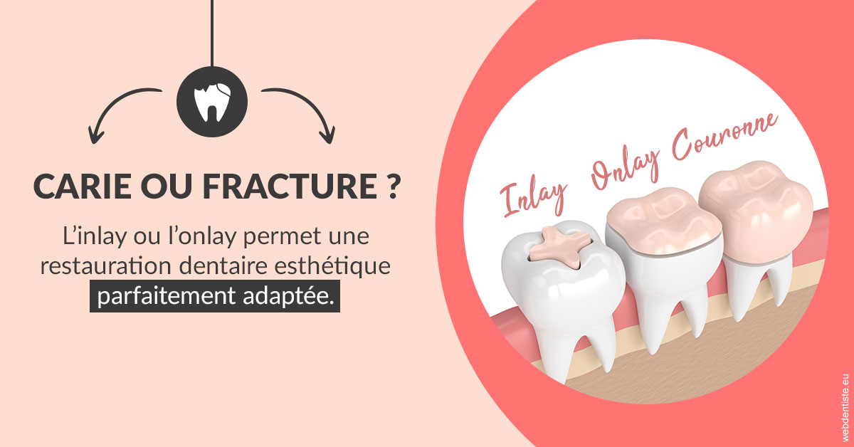 https://dr-fontaine-philippe.chirurgiens-dentistes.fr/T2 2023 - Carie ou fracture 2