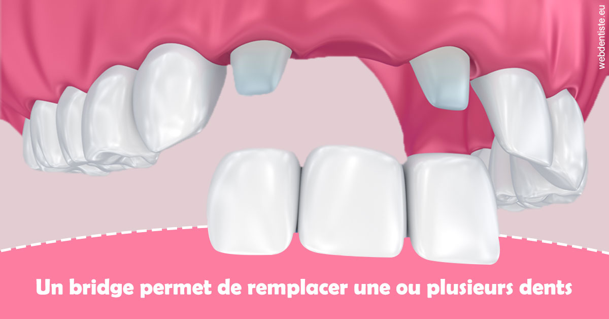 https://dr-fontaine-philippe.chirurgiens-dentistes.fr/Bridge remplacer dents 2