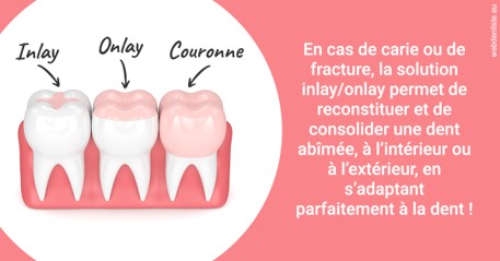 https://dr-fontaine-philippe.chirurgiens-dentistes.fr/L'INLAY ou l'ONLAY 2