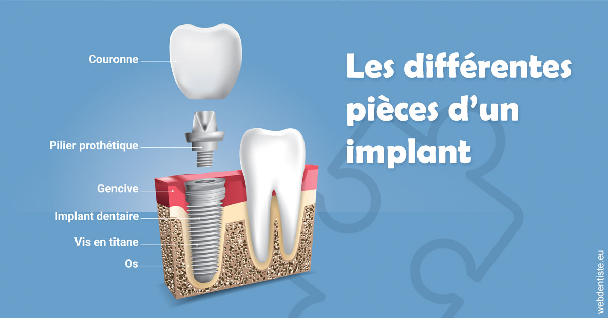 https://dr-fontaine-philippe.chirurgiens-dentistes.fr/Les différentes pièces d’un implant 1